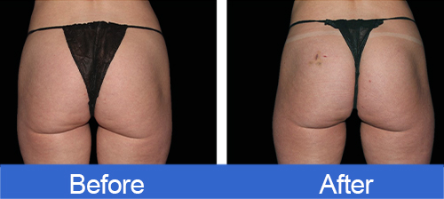 ems PurenaSculpt before and after