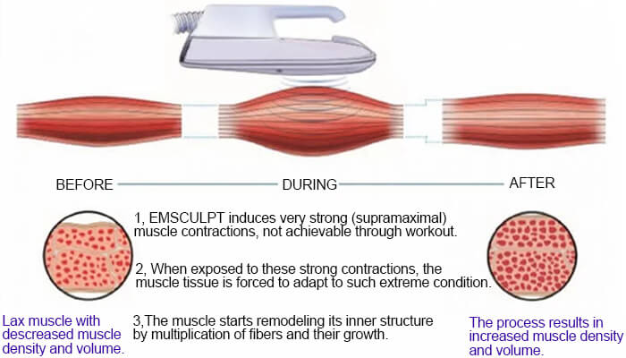 High-Intensity Focused Electro-Magnetic (HIFEM) field technology High-Intensity Focused Electro-Magnetic (HIFEM) field technology