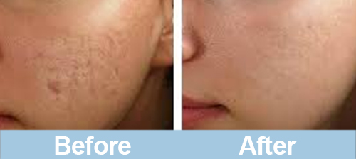 microneedling before and after