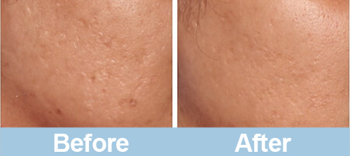 microneedling before and after