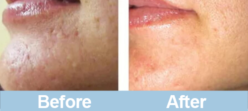 microneedling before and after