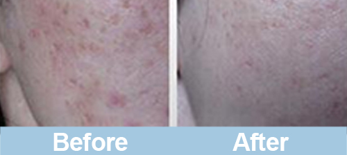 microneedling before and after