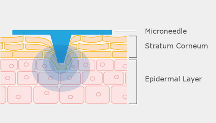 Microneedling skin therapy