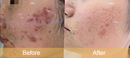 Repair acne scars