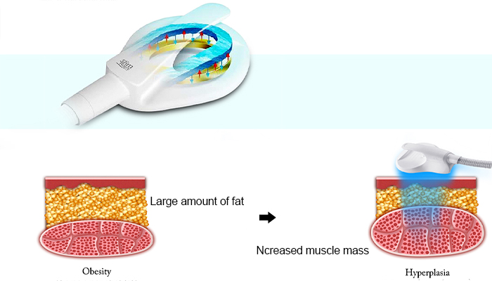 High-Intensity Electromagnetic Muscle Trainer Technology 