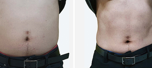 ems treatment before and after for abdomen