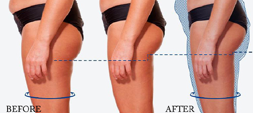 ems treatment before and after for thighs