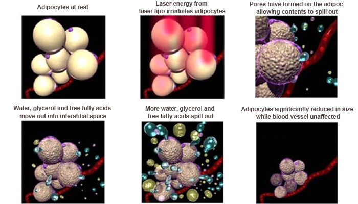 How does laser lipo machine work?