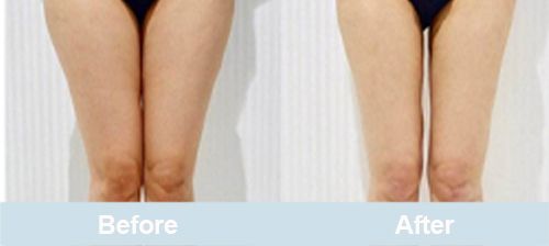 laser lipolysis before and after inner and outer thighs