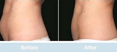  lipolysis laser before and after love handles
