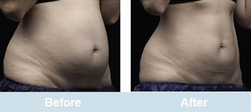 laser lipolysis before and after picture