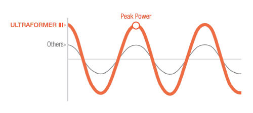 Dual engine enables high peak power & less pain