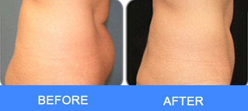 Waist Fat Removal