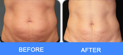 Abdomen Fat Removal