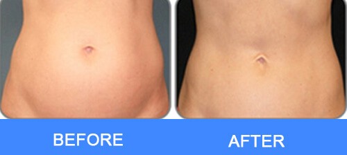 Belly Fat Removal