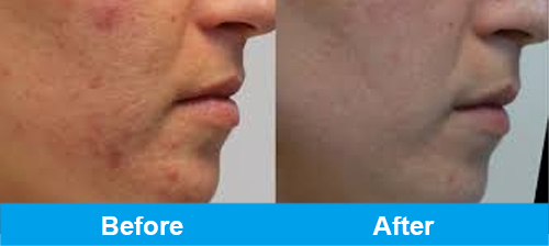 Acne treatment