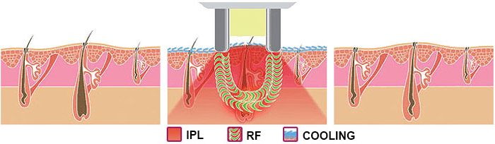 IPL hair removal