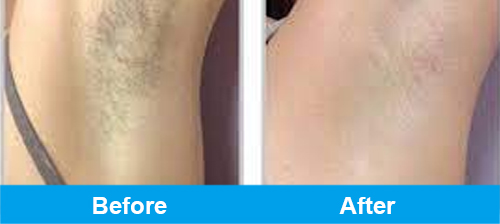 armpit ipl hair removal before after