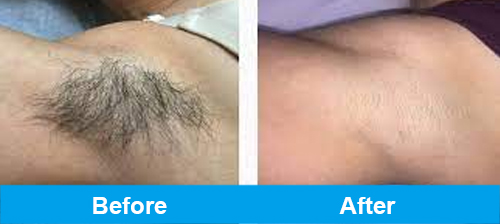 ipl hair removal before after