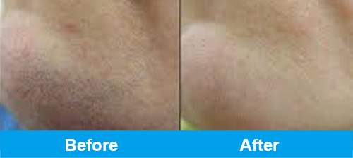 ipl hair removal before after