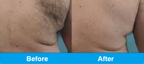 ipl hair removal before after