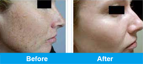 ipl pigmentation treatment