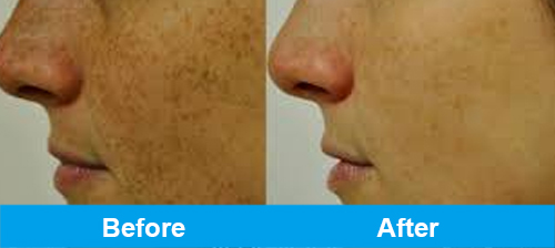 ipl pigmentation treatment