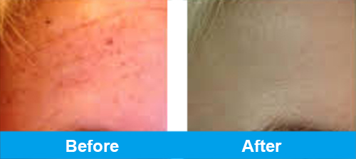 ipl pigmentation treatment