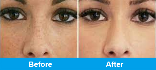 ipl pigmentation treatment