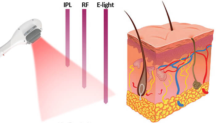 What is ipl hair removal?