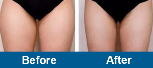 Upper Legs Treatment of emslim