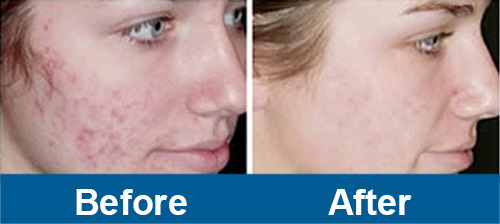 led light therapy before and after