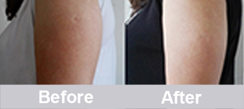 velashape before and after