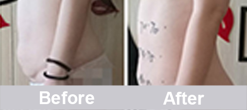 velashape before and after