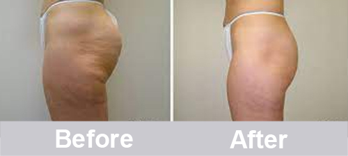 velashape before and after legs