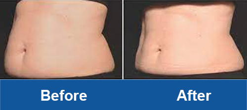 coolsculpting before and after