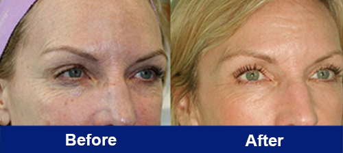 Before and after radiofrequency therapy on the upper and lower eyelid