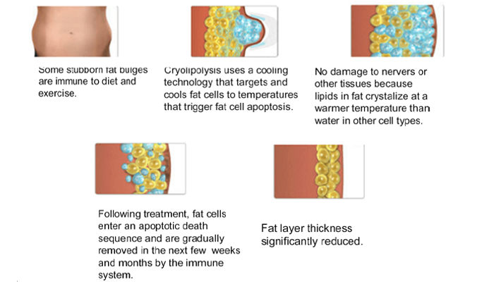 How does coolsculpting elite machine PL-B360 work?