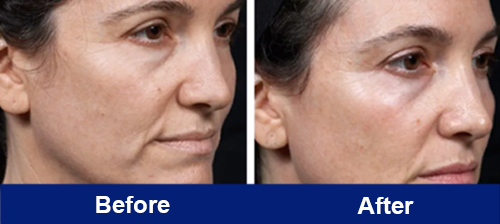 Before and after radiofrequency therapy on the face