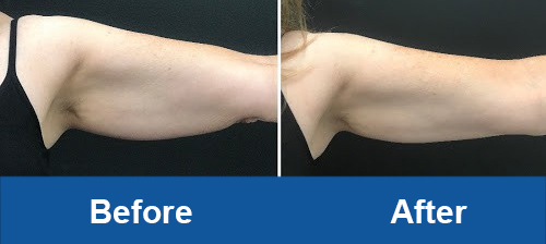 coolsculpting before and after arms