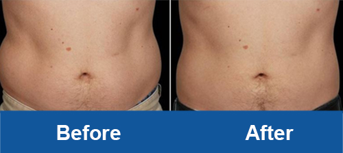 abdomen coolsculpting before and after