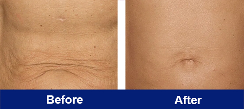 Before and after radiofrequency therapy on the abdomen area