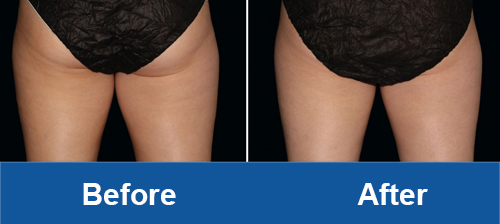 thigh coolsculpting before and after