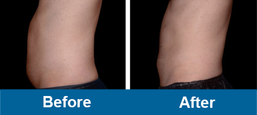 ems PurenaSculpt abdomen before and after