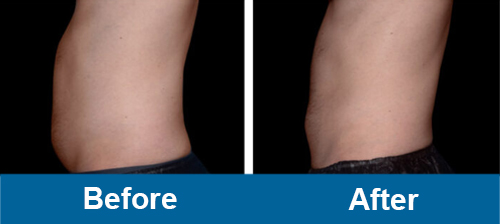 Ems PurenaSculpt  abdomen before and after