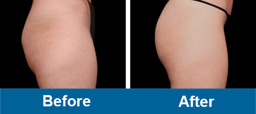 ems PurenaSculpt buttlifting before and after