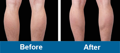 ems PurenaSculptcalves before and after