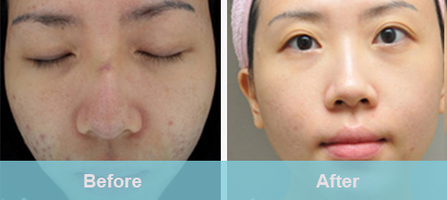 eliminate acne treatment before and after