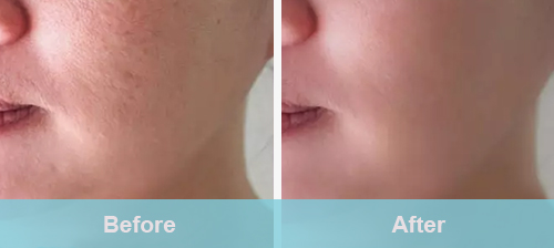 shrink pores treatment before and after