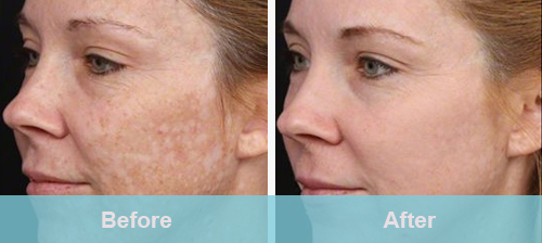 subcutaneous pigment chloasma treatment before and after